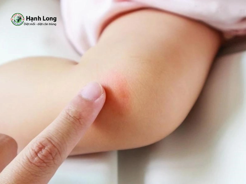 Bị muỗi vằn đốt có sao không? Dấu hiệu và cách phòng sốt 