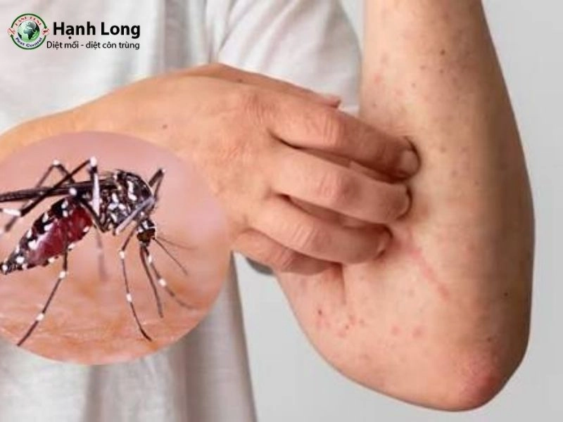 vết đốt của muỗi sốt xuất huyết