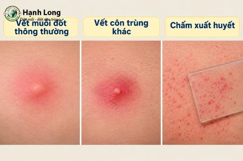 vết đốt của muỗi sốt xuất huyết