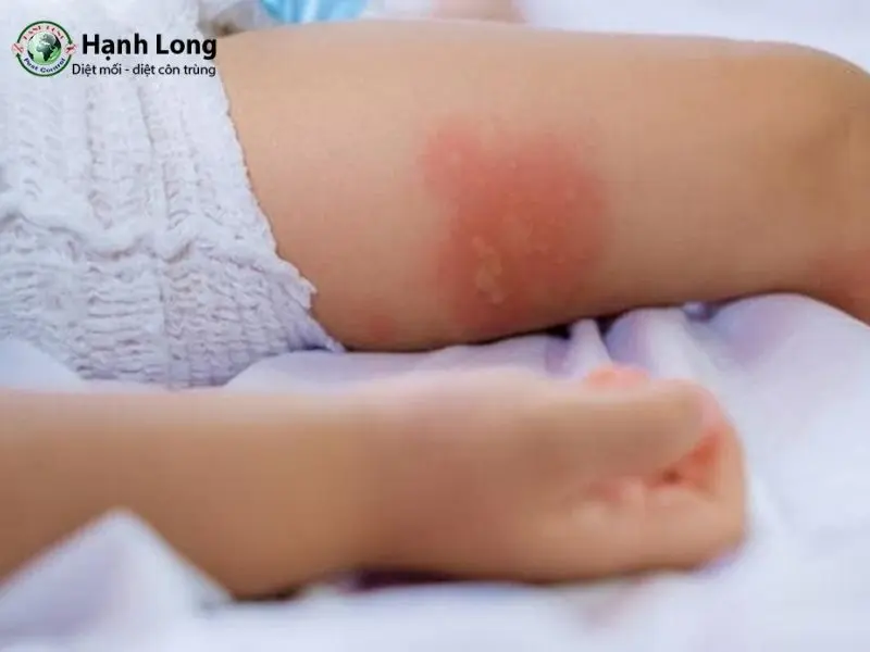 bị muỗi đốt