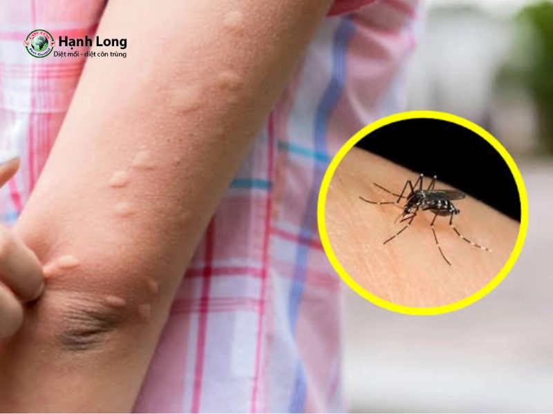 Muỗi bị thu hút bởi gì? 5 lý do bạn hay bị đốt nhất 