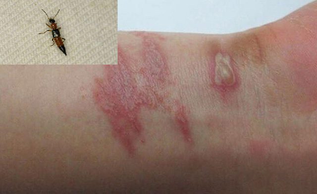 Một số triệu chứng khi bị kiến ba khoang cắn