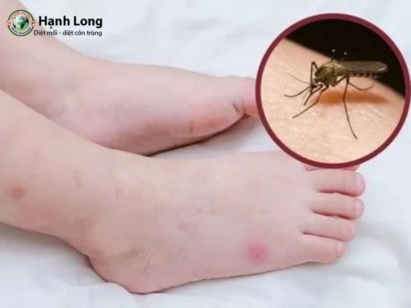bị muỗi đốt
