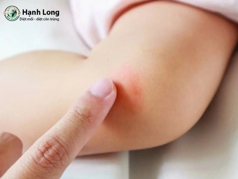 bị muỗi đốt
