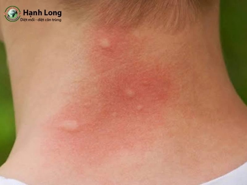Bị muỗi đốt nhiều có sao không? Tác hại và nguy cơ cần biết